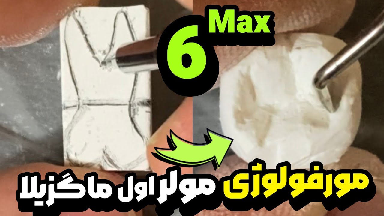 Dental Anatomy : carving of maxillary first molar/tooth morphology مورفولوژی دندان مولر اول ماگزیلا