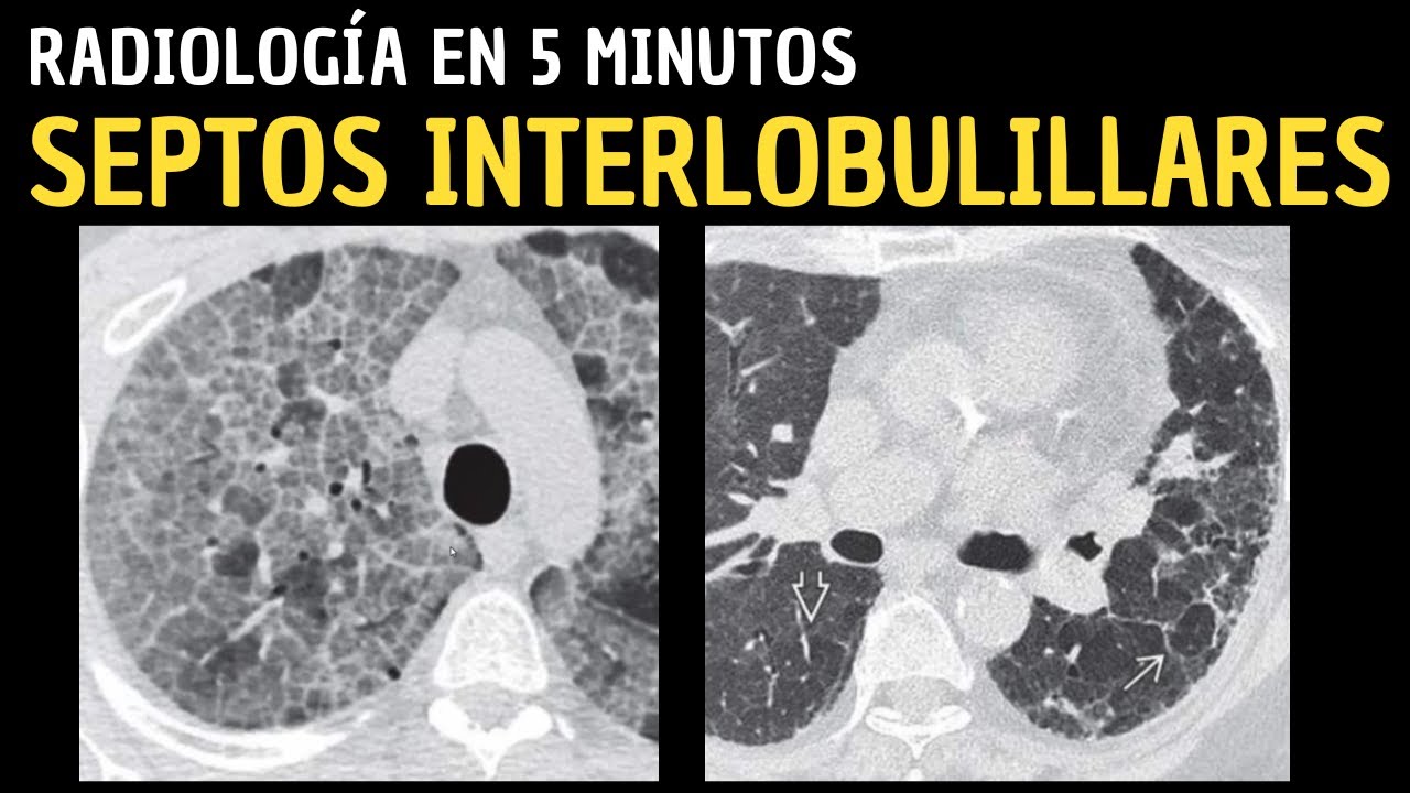 Radiología en 5 minutos: Signos radiológicos pulmonares: Septos interlobulillares.