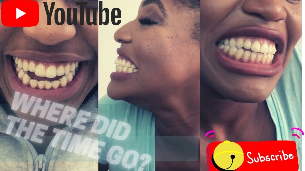 Open Bite Ortho Journey #12🙈 - 8 Month Invisalign Update!