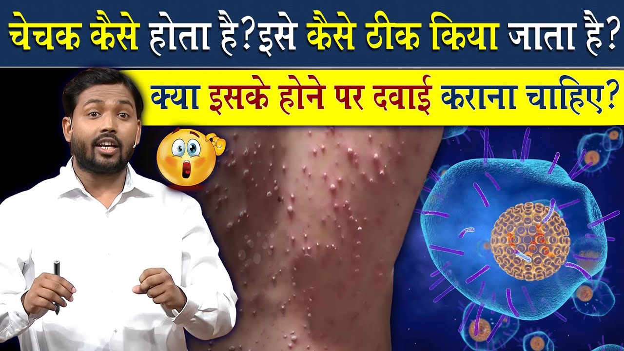 चेचक (Chicken Pox) क्यों होता है? चेचक होने पर क्या करें?
