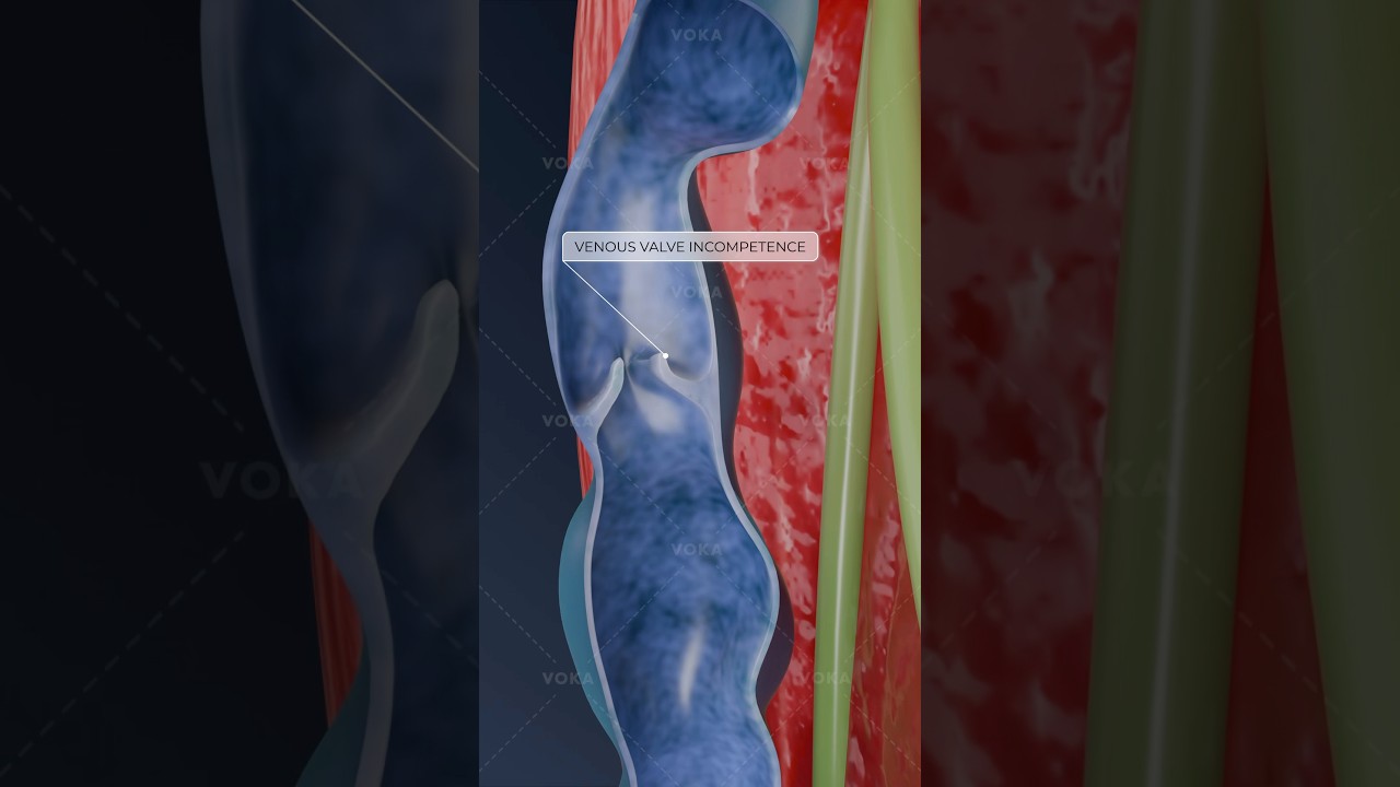 What is varicosity of the superficial veins and how can it impact your health? Explore in 3D