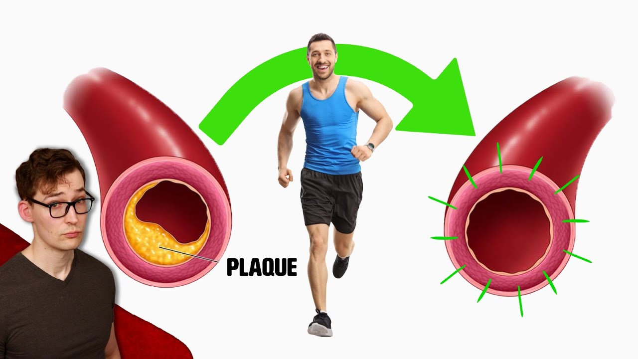 Exercise shrinks Plaque, but it does more than that&hellip;