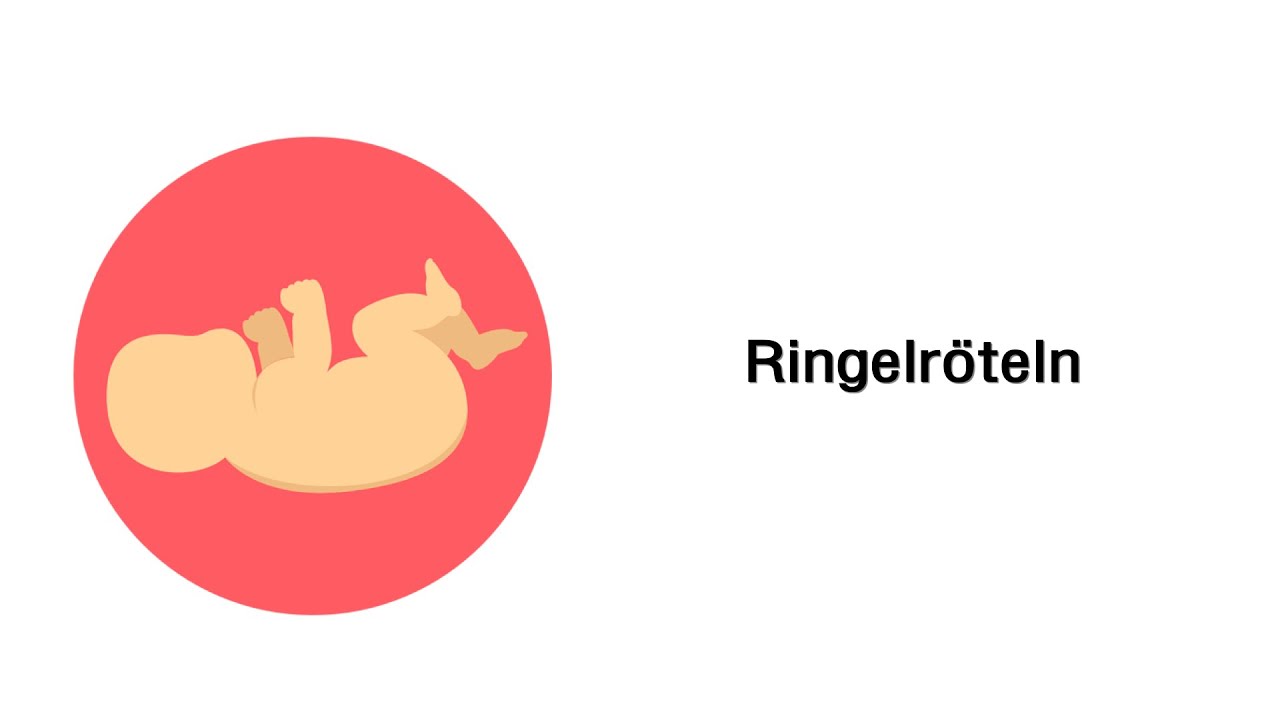 Ringelröteln - Kinderkrankheiten