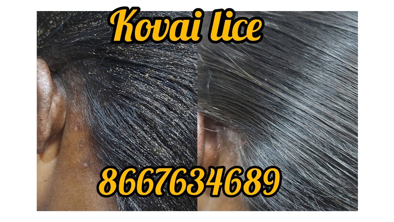 lice treatments #nits&licetreatments pennu eerru Coimbatore con 8667634689