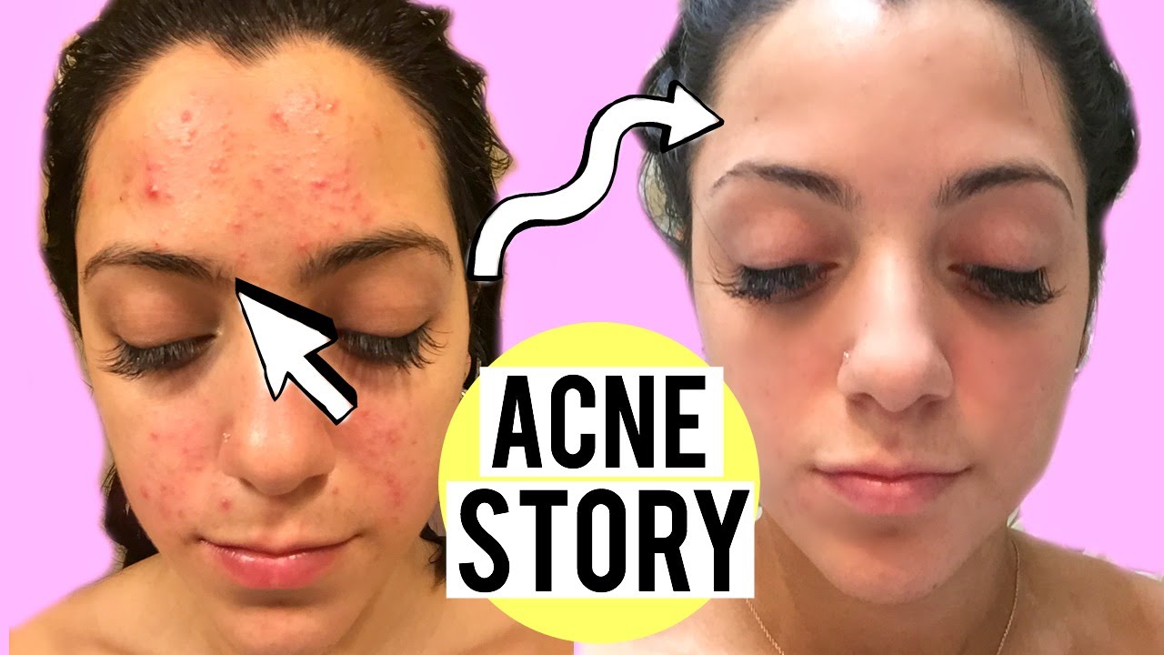 My Acne Story: Clogged Pores to Clear Skin | How I cleared my Skin