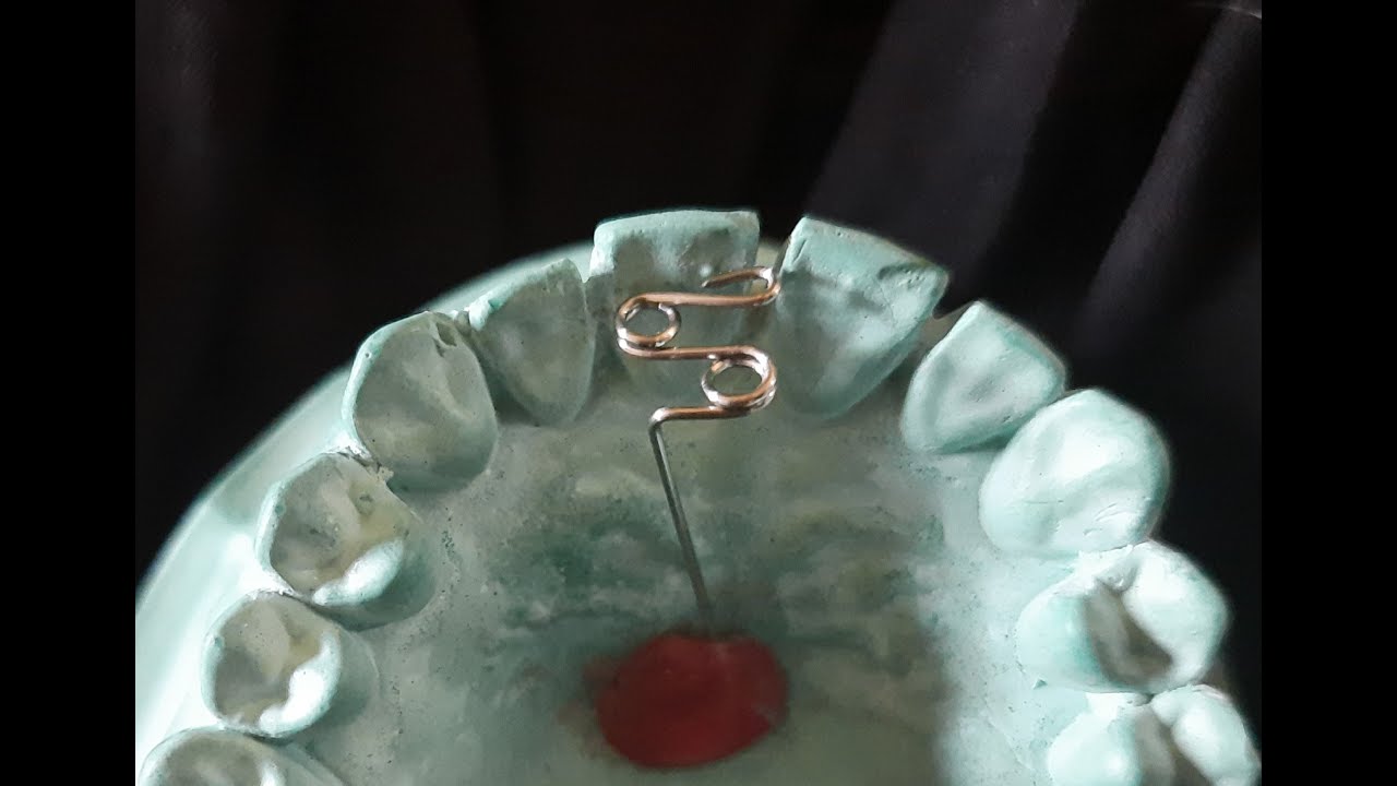 Z Spring or Double Cantilever Spring with Indications | Removable Orthodontic Appliance|Orthodontics