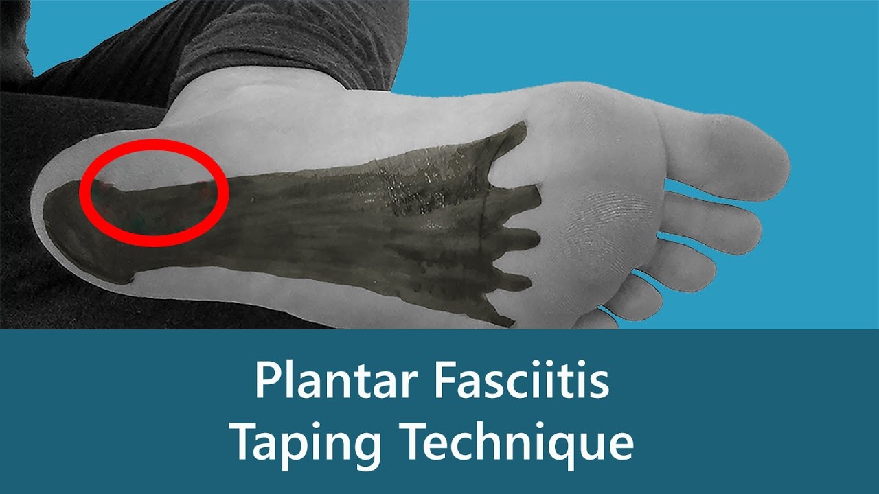 Plantar Fasciitis Taping Technique