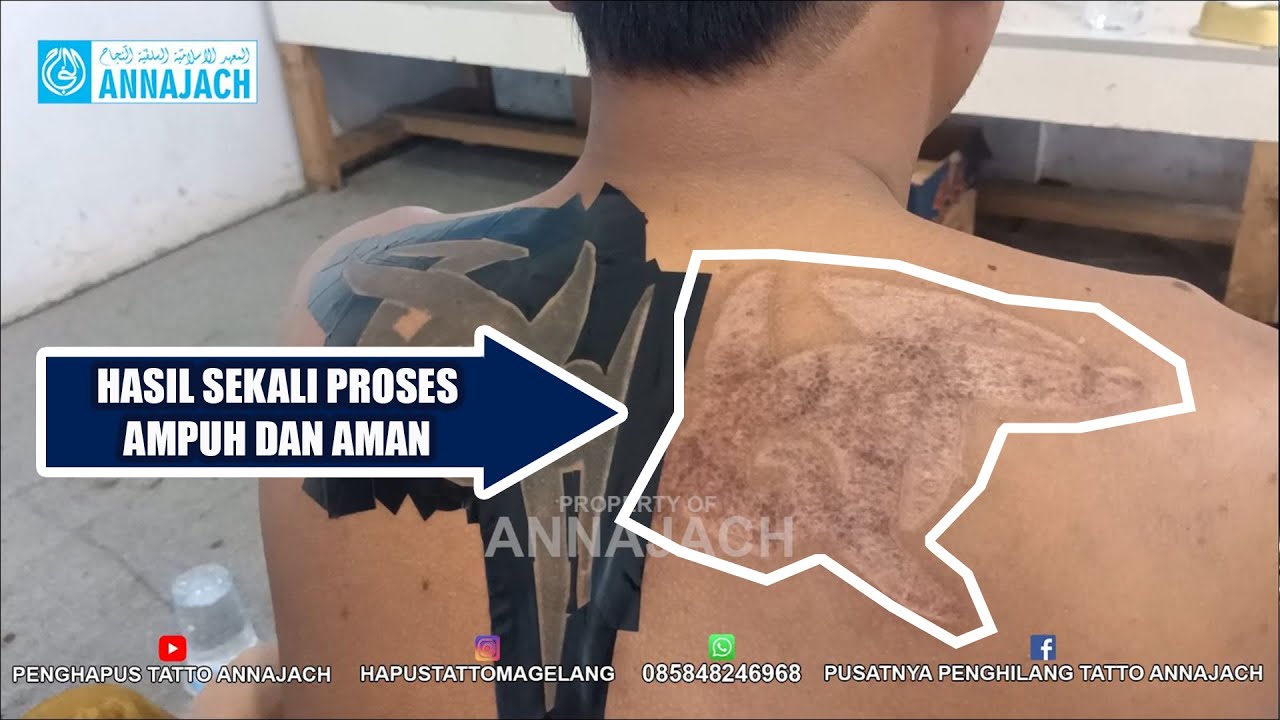 CARA MENGHAPUS TATTO DENGAN OBAT RACIKAN SANTRI ANNAJACH