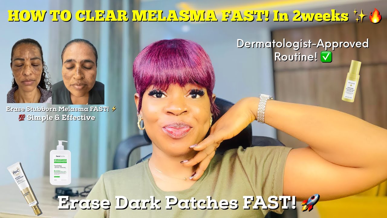 How To CLEAR Melasma  FAST & PERMANENTLY 🔥 | Best Pigmentation Treatment On Face + Melasma Skincare✨