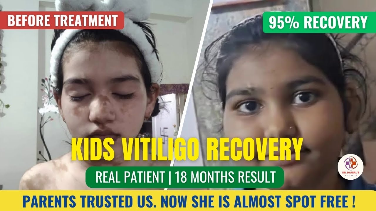 Kids (Children) Vitiligo Recovery Success | 95% Cleared in 18 Months @ Dr Danial clinic | #kids