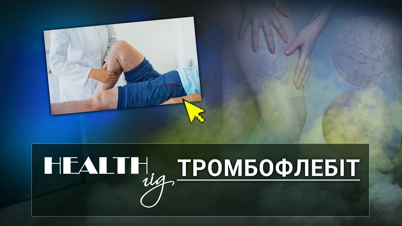 «Health - гід». Тромбофлебіт