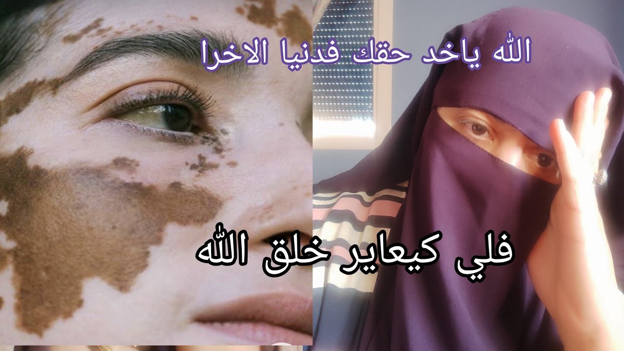 من بعد الزواج ديالي خرج لي البرص في وجهي 😱 وعجوزتي ما رحماتني 🙆🏽 ولكن الله صيفط لها البرس لبناتها