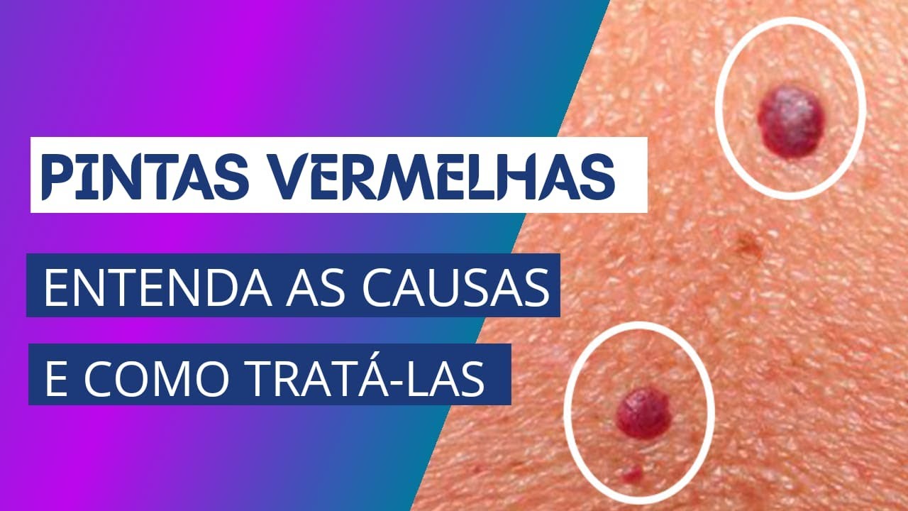 Pintas vermelhas - Entenda as causas e como tratá-las
