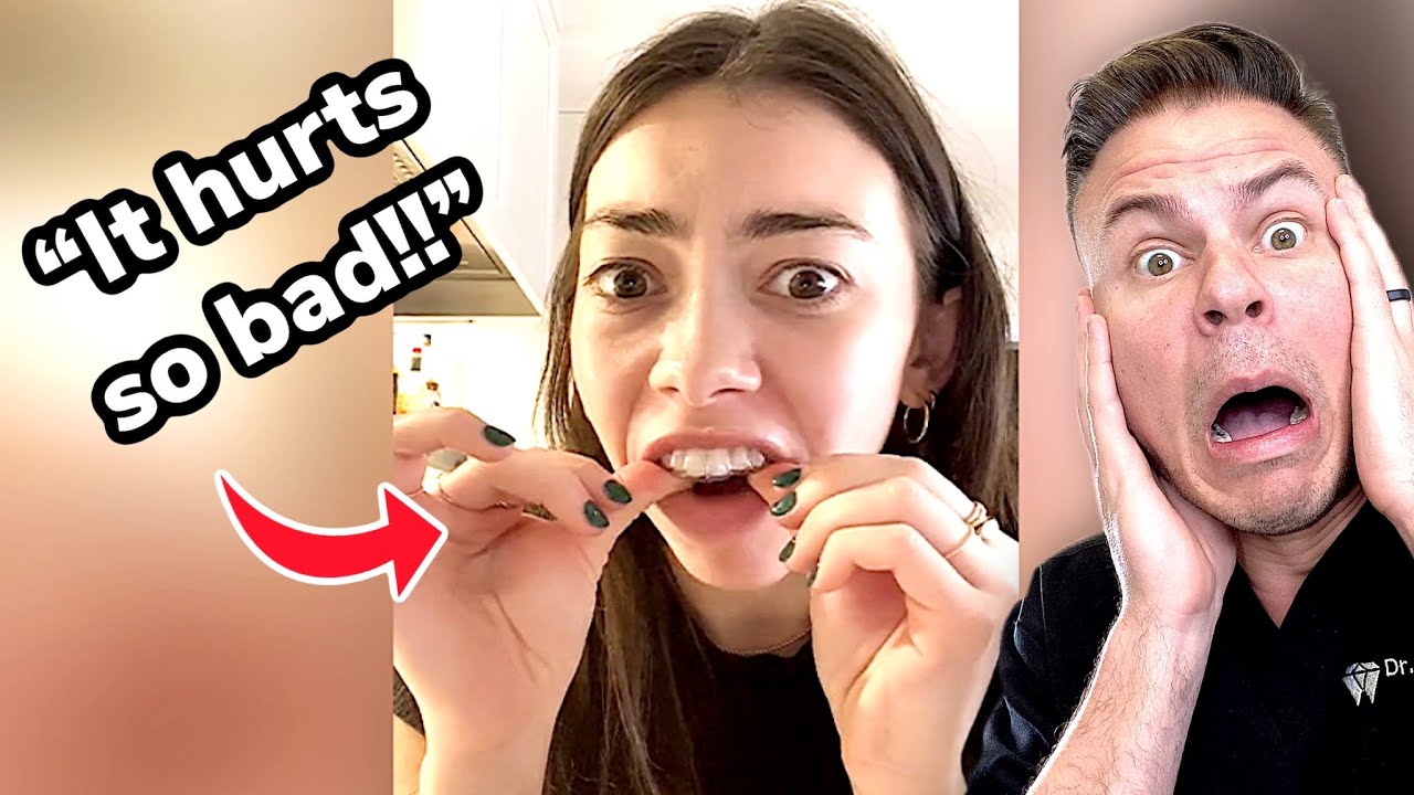 She Didn&rsquo;t Wear Her Retainers For MONTHS&hellip; She Put Them In And THIS Happened | TheBentist