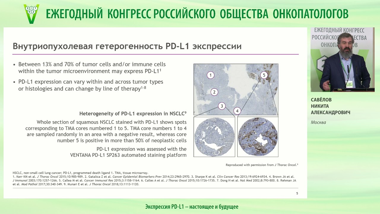Экспрессия PD-L1 &ndash; настоящее и будущее
