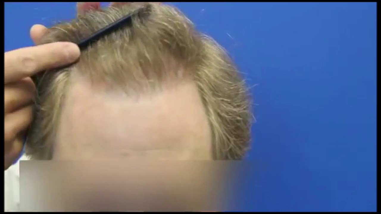 4000 FUE: Nuhair Medical - Hair Transplant Vancouver, Edmonton, Calgary, Winnipeg, Regina