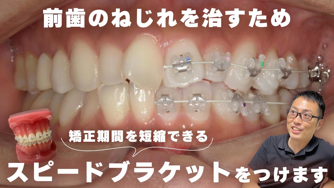【スピードブラケット装着】表側ワイヤー矯正装置をつけるところ、全て見せます！【翼状捻転】