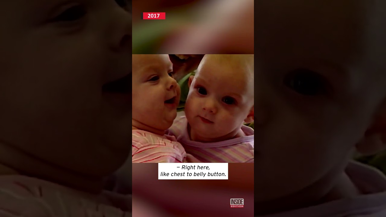 Formerly Conjoined Twins Meet #shorts