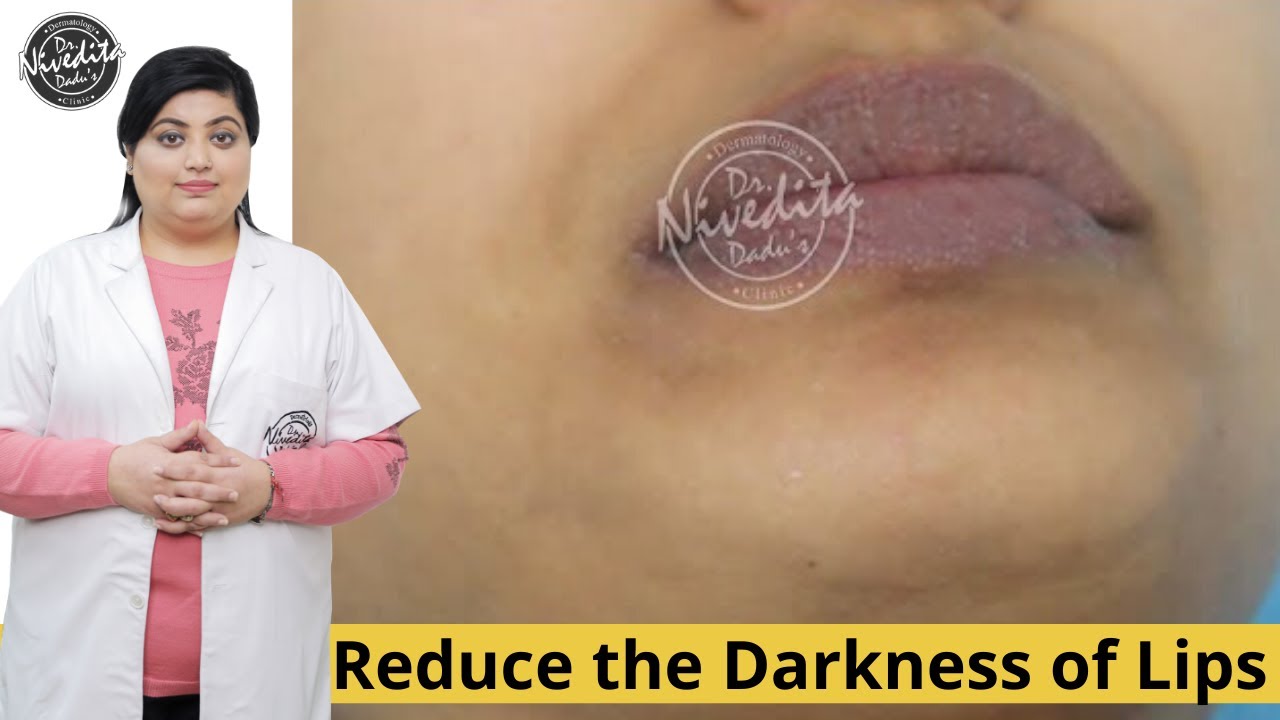 Black/Dark Lips Treatment by Dermatologist | Laser Lip Lightening for Dark Lips