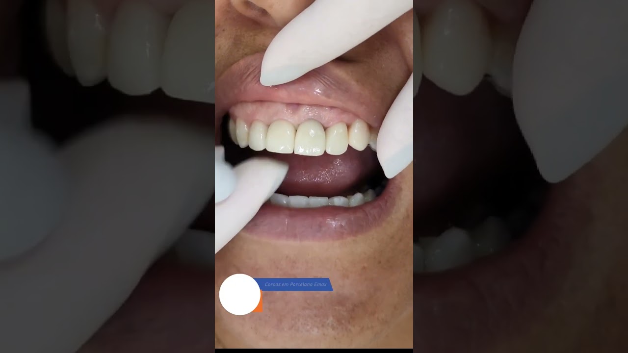 mais um trabalho com Coroas de porcelana realizado.