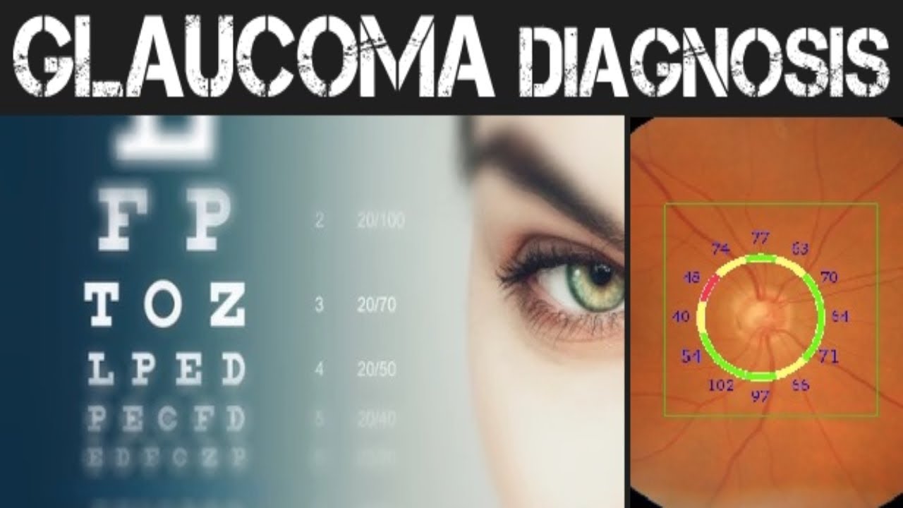 How Glaucoma is Diagnosed & Managed