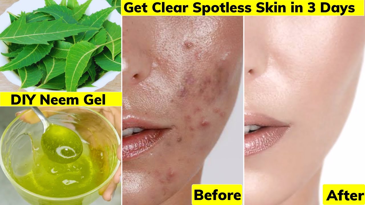 I applied👆🏼this Face Cream Gel on Acne, Pimples, Pigmentation,Bumps-Got Clear Glowing Skin in 3 Days