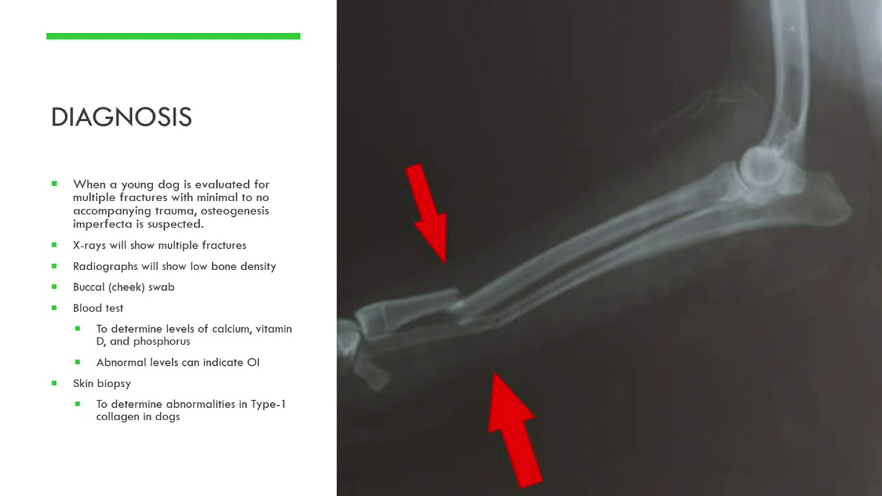 Osteogenesis Imperfecta