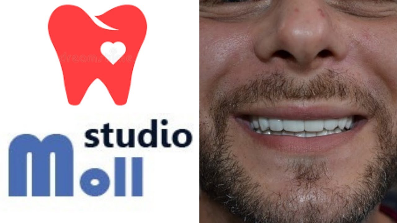 Snap on Smile: l'Estetica immediata di un Sorriso. Un Testimonial