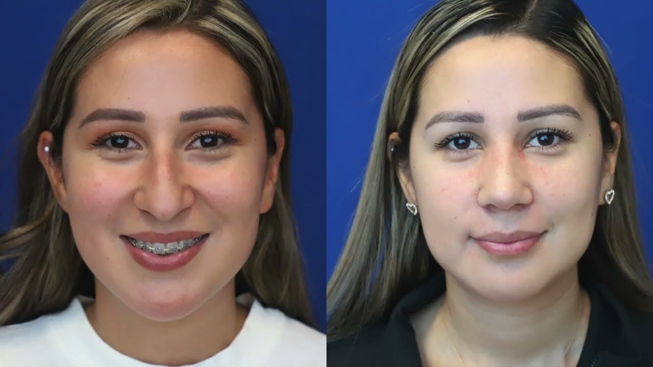 An Amazing and Natural Transformation ! | Rhinoplasty by dr. Ali sajjadian | Balanced Rhinoplasty