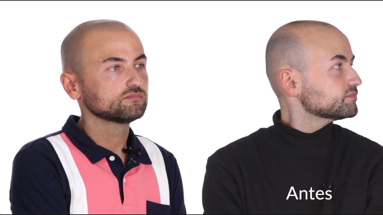 Micropigmentaci&oacute;n capilar Zaragoza-Madrid