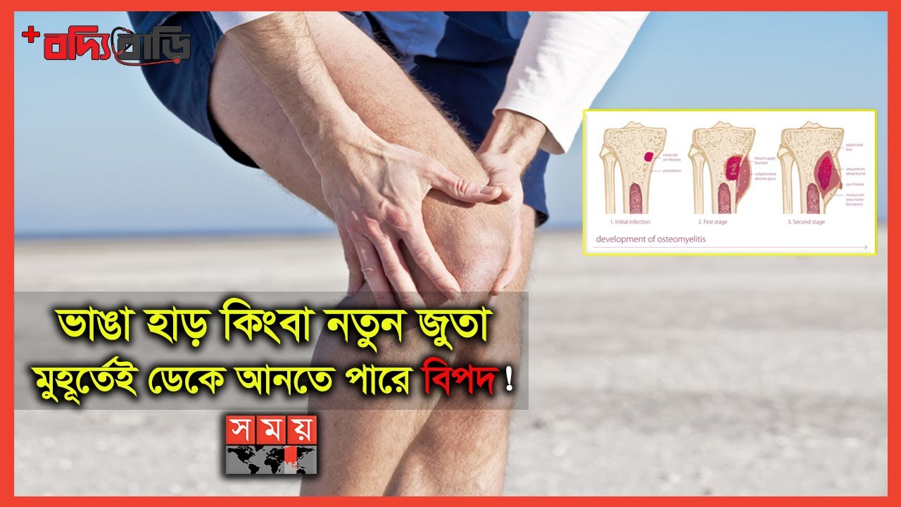 হাড়ের ইনফেকশন ও চিকিৎসা | বদ্যি বাড়ি | Bone Infection | Osteomyelitis | Somoy TV