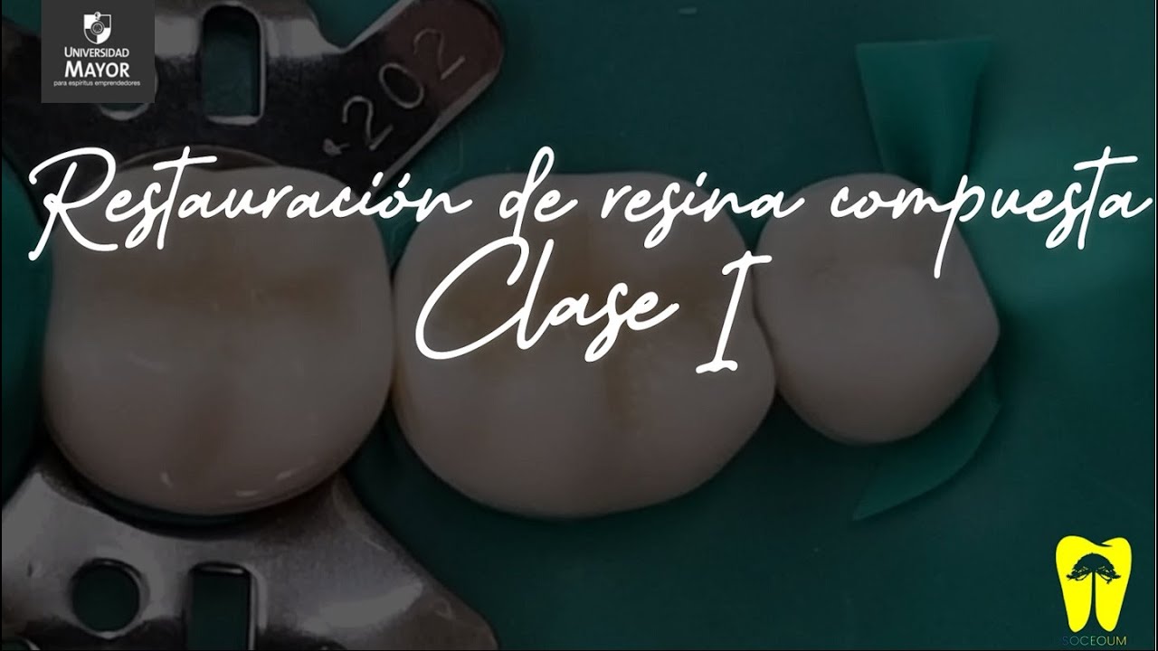 Restauración de resina compuesta clase I | Paso a paso