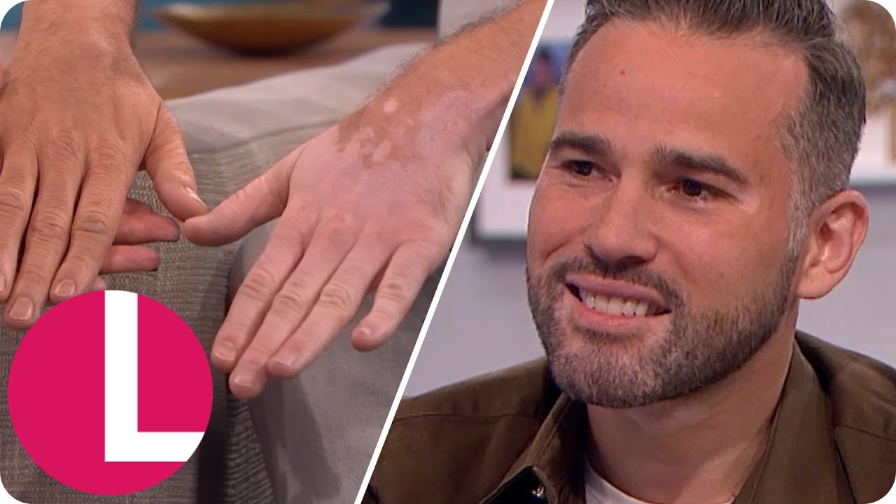 Dean Edwards Reveals His Vitiligo to Lorraine | Lorraine