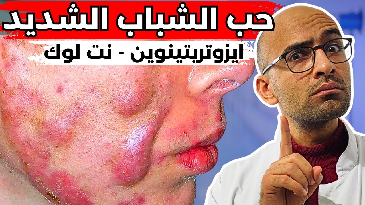 علاج حب الشباب الشديد (ايزوتريتينوين - نت لوك) | قصة مستر عزيز اللي عنده بقاليظ !