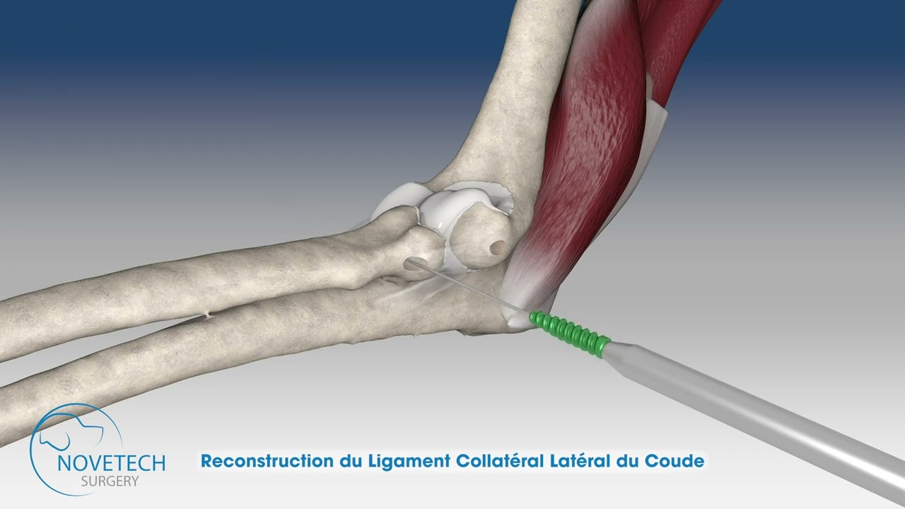 Reconstruction du ligament collatéral latéral du coude avec NOVALIG®