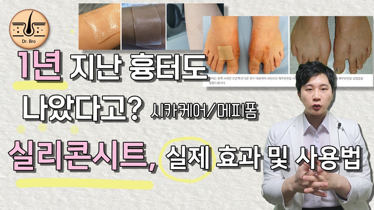 실리콘시트(메피폼, 시카케어), 흉터가 실제 얼마나 줄어들었을까? 사용 기간, 효과, 사용법 - 수술 흉터 치료법