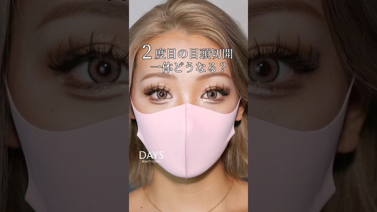 【二重整形】他院修正お任せください！