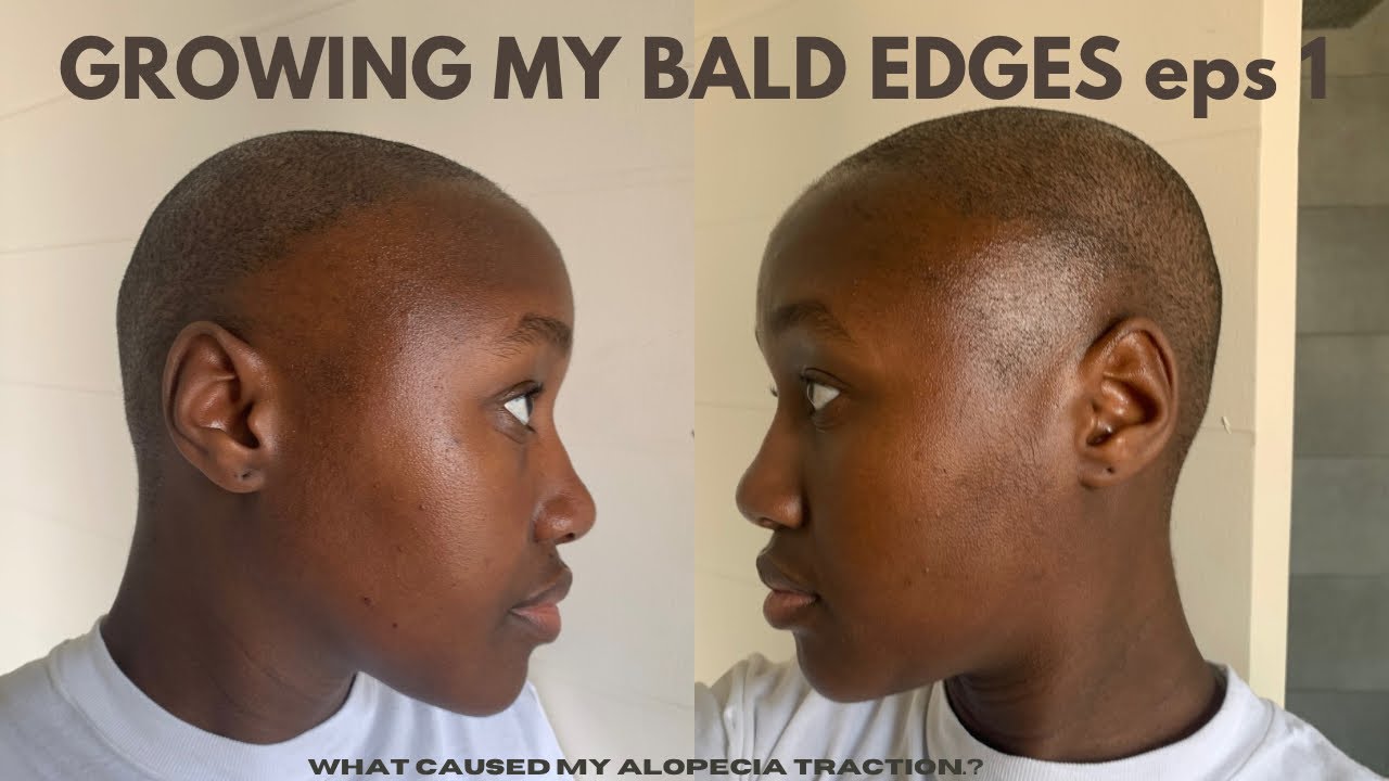 I SHAVED MY HAIR OF AFTER 7 YEARS OF ALOPECIA TRACTION.