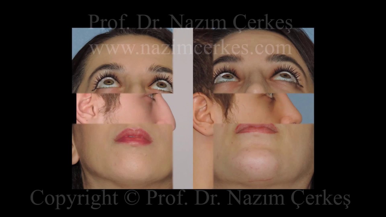 Burun Estetiği ve Çene İmplantı Ameliyat Öncesi Sonrası Fotoğraflar