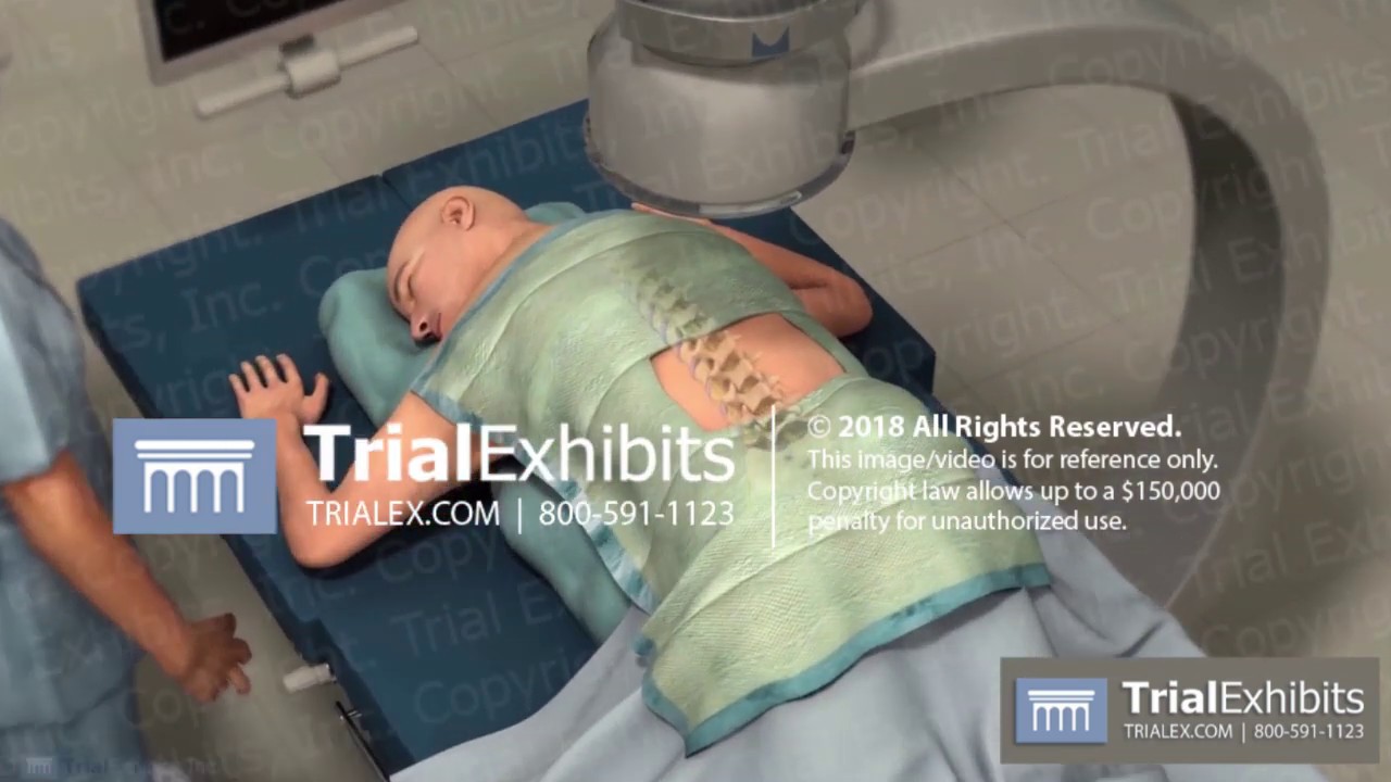 Percutaneous Lumbar Laser Discectomy and Neural Decompression