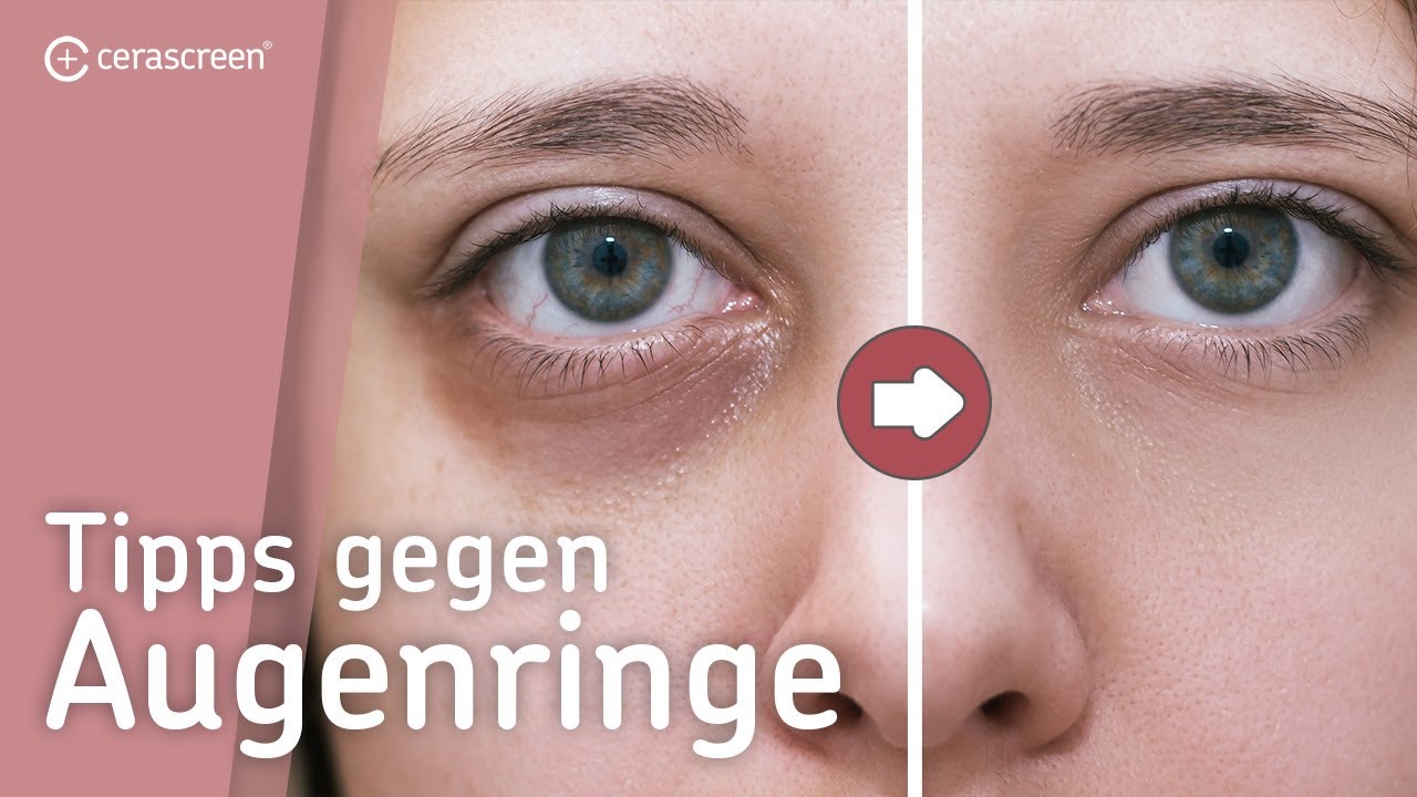 3 Tipps gegen Augenringe | Ursachen eines Eisenmangels
