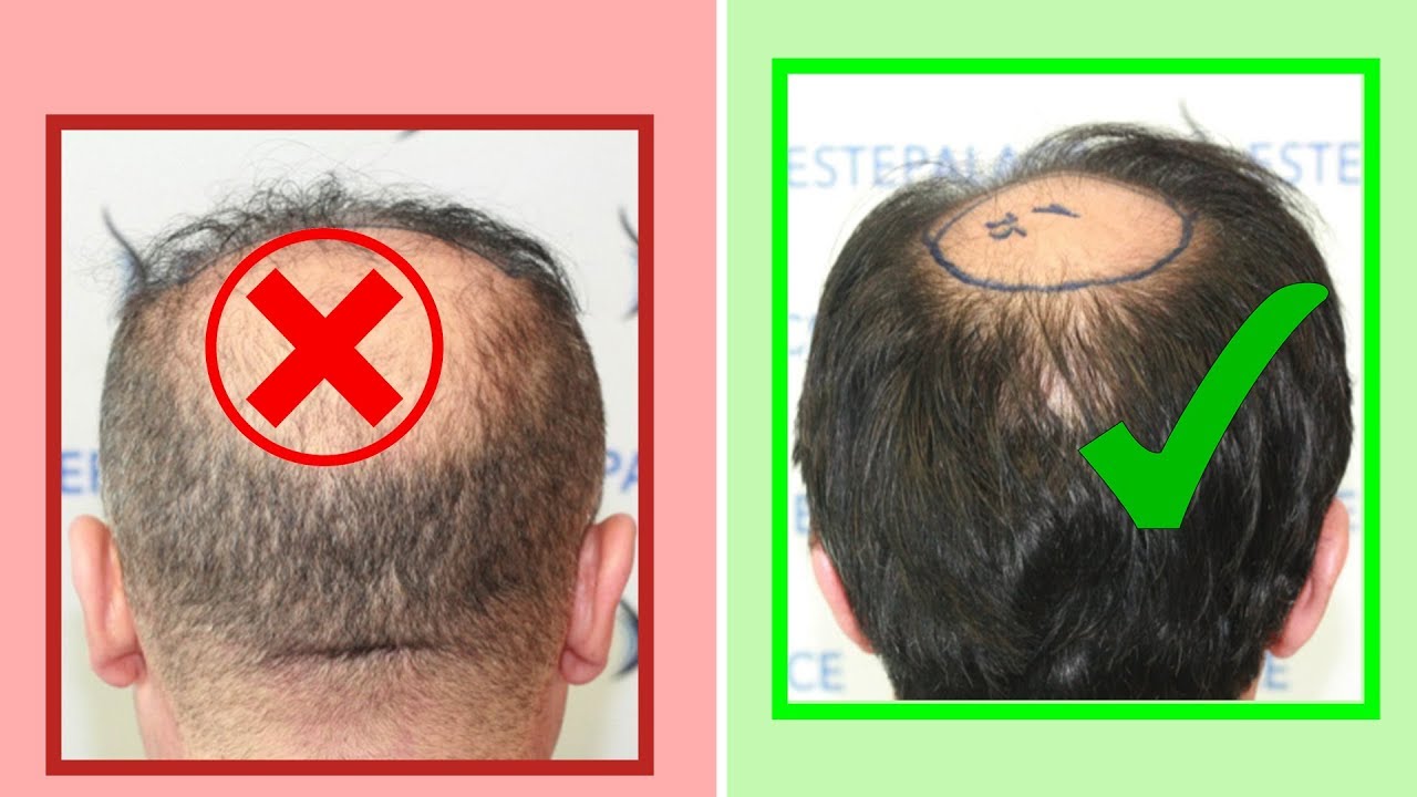 3 SIGNS You are a Good Hair Transplant Candidate!