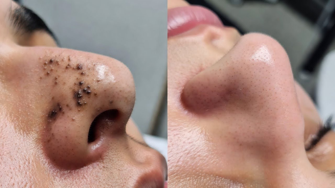 Blackhead Removal Before & After | Deep Cleansing & Pore Cleaning Results