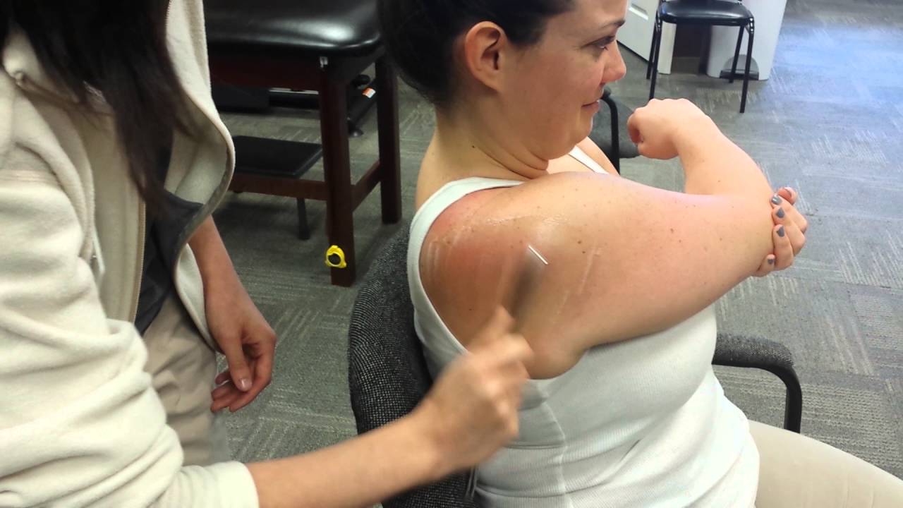 IASTM of shoulder
