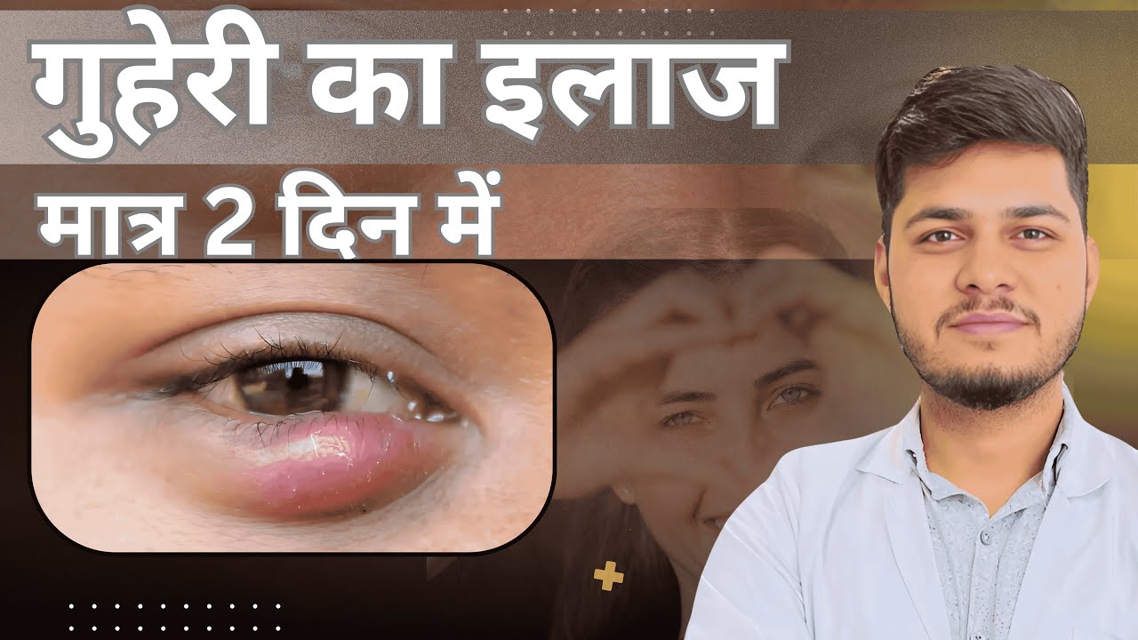 आंख की गुहेरी दूर करने के घरेलु उपाय | Eye doctor tips to get rid of a Stye | 100% Result