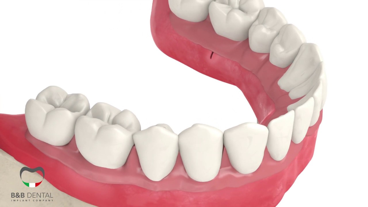 All on four on B&B Dental implants