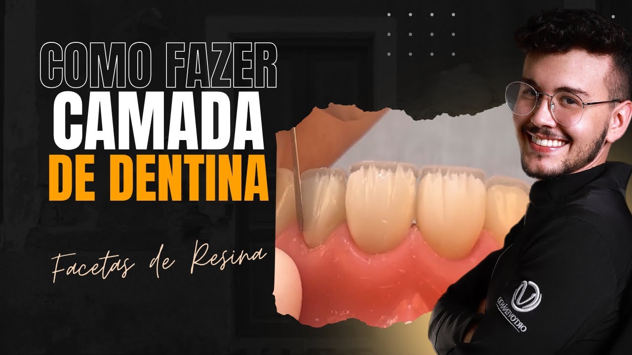 Tutorial Como fazer Camada de Dentina (Facetas em Resina Composta) - Lucas Venâncio