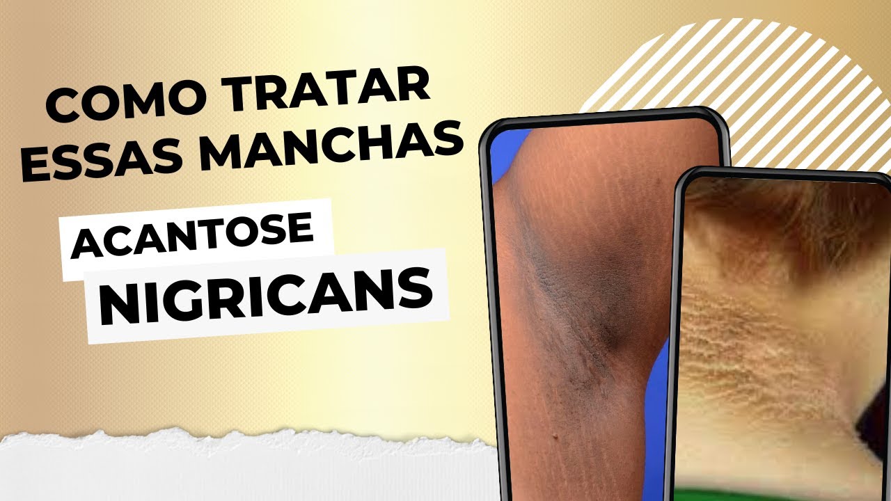 Acantose Nigricans - Descubra as possíveis causas e como tratar
