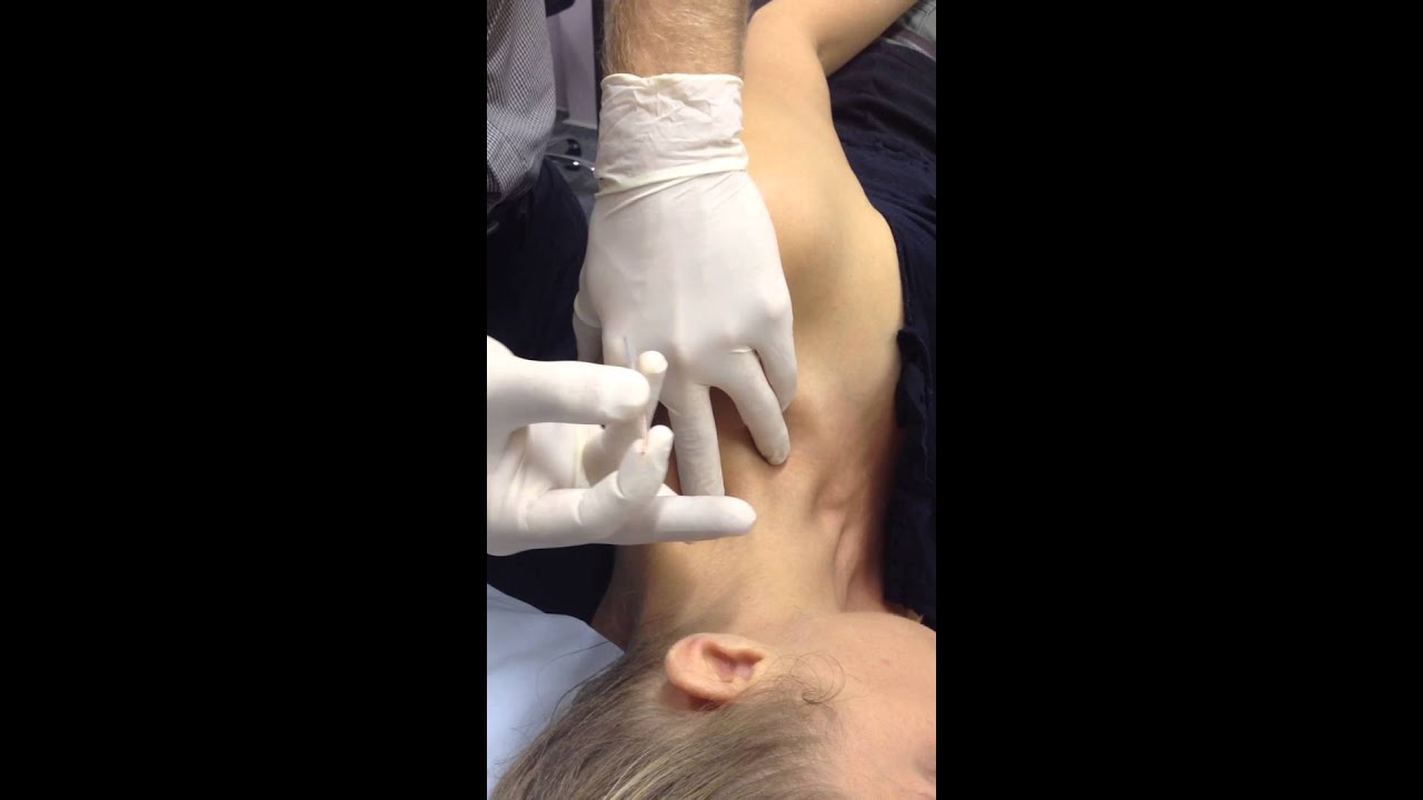 Levator Scapulae Dry Needling