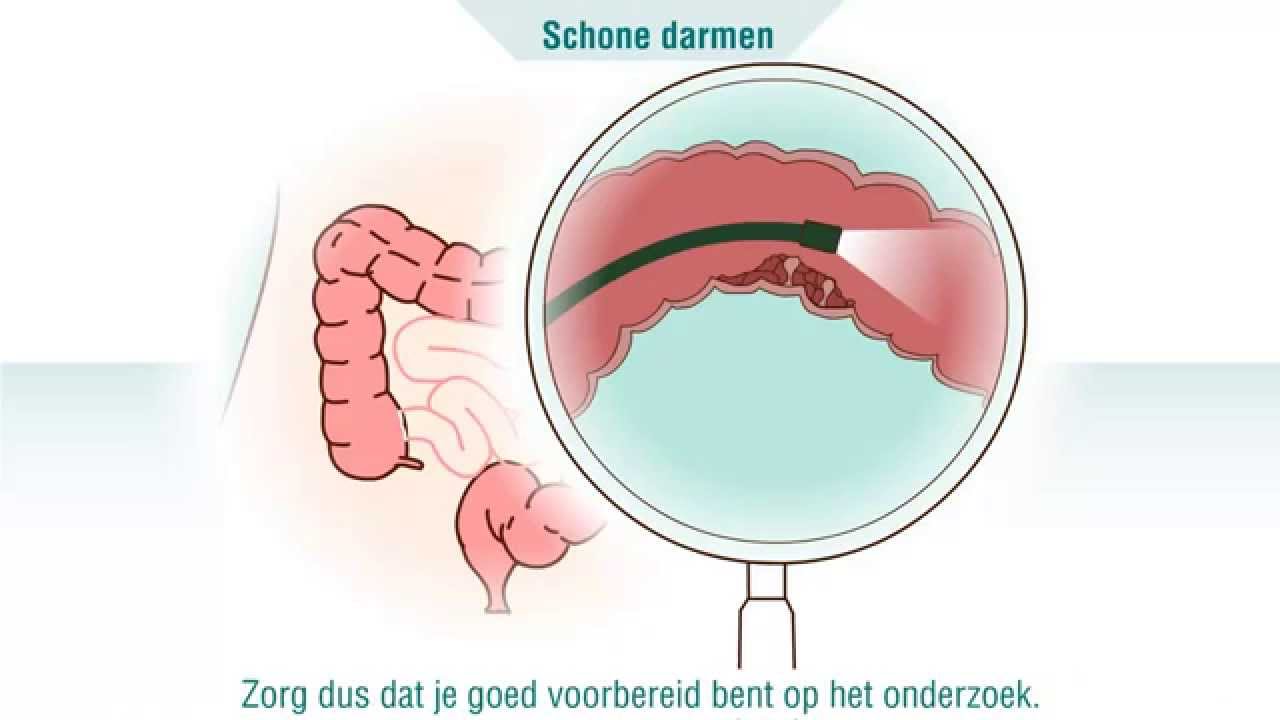 Coloscopie - Wat is het?